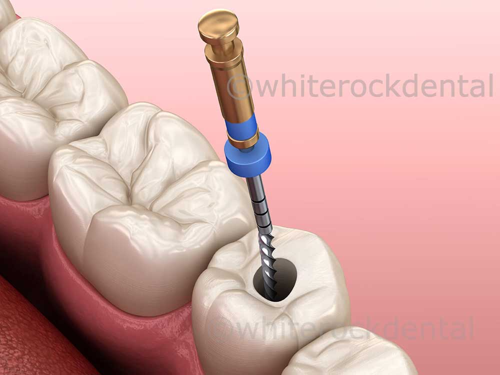 Endodontics