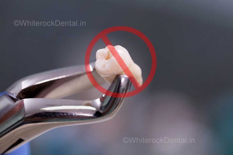 Save your tooth from extraction