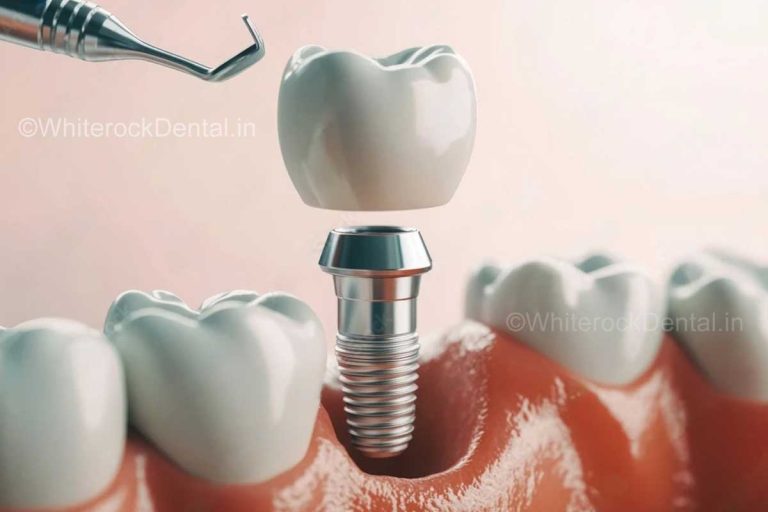 root canal vs dental implant