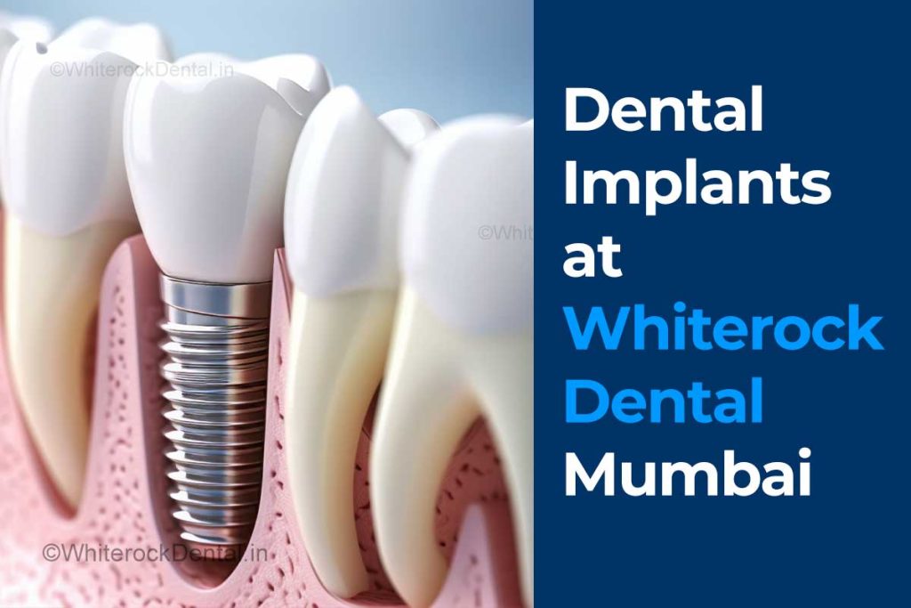 is getting a dental implant painful in Mumbai