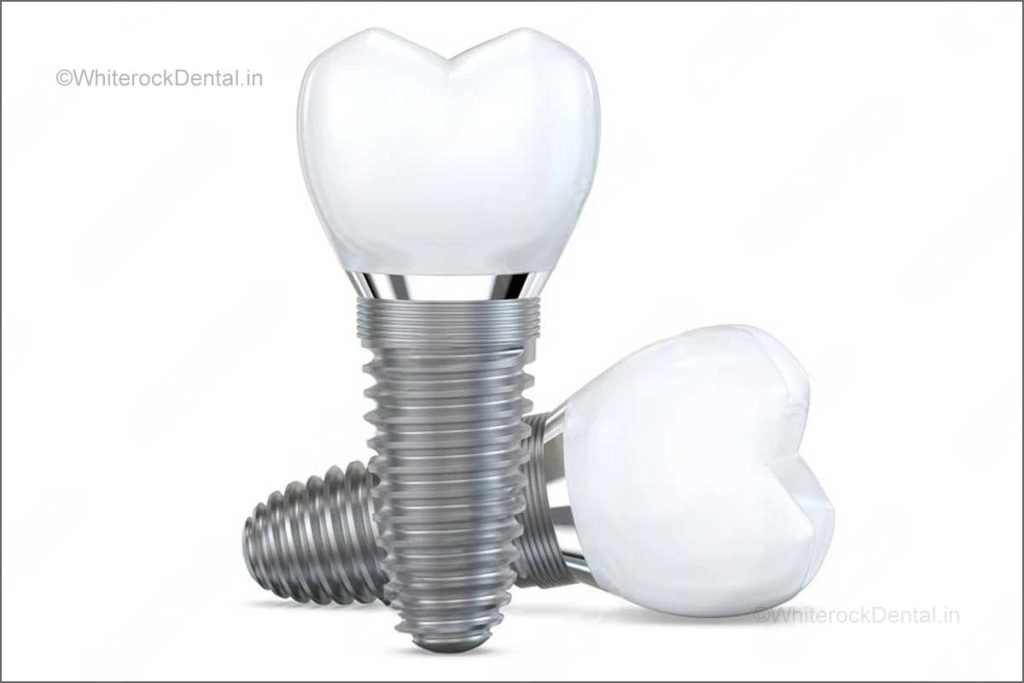 How to Maintain Your Dental Implants for a Lifetime