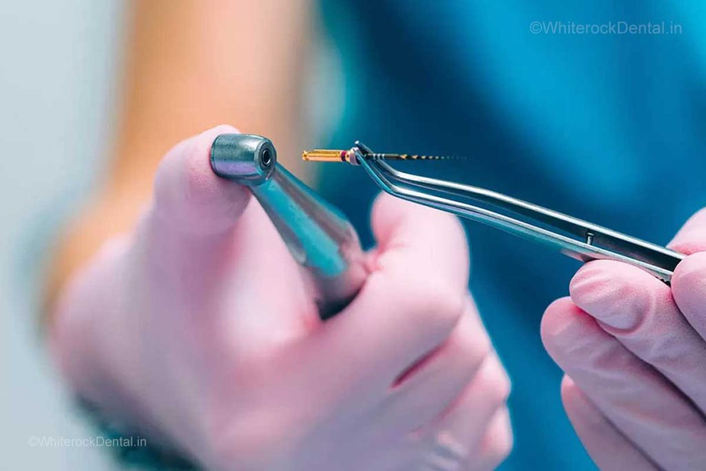 Pain-Free Root Canal in Wadala