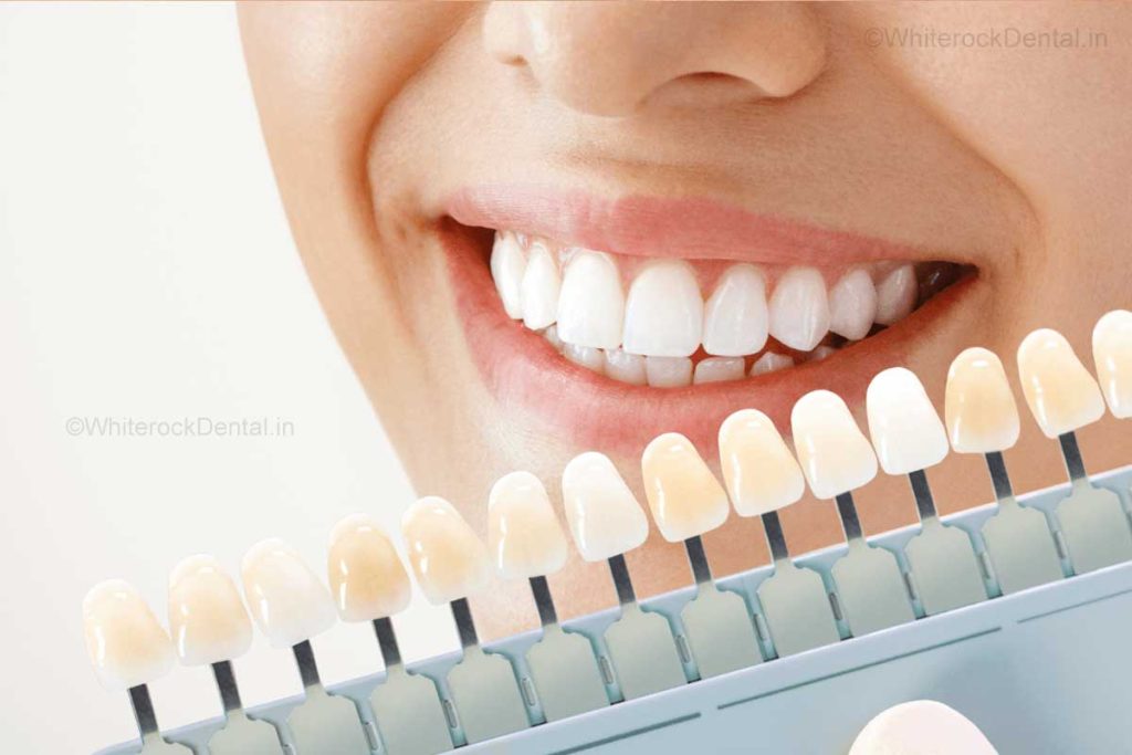 Teeth Whitening Myths vs Facts