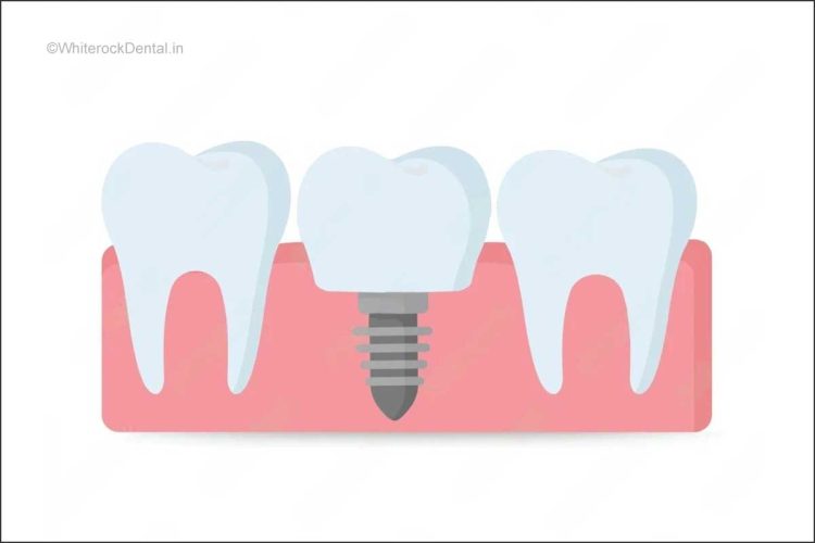 Mini Dental Implants 101: The Small Solution with Big Results ...