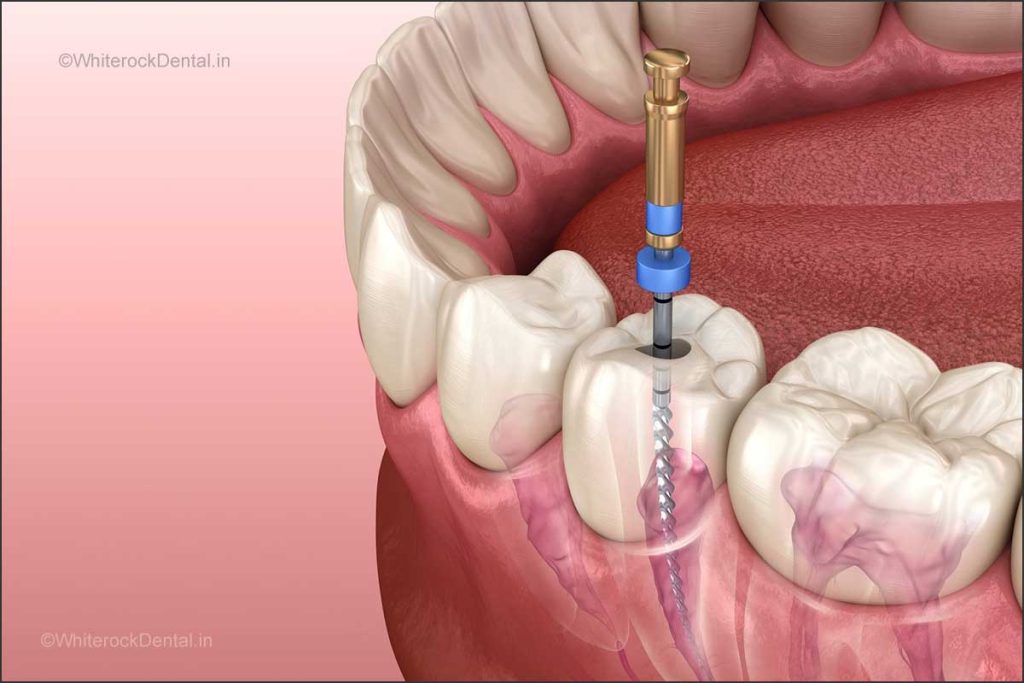 Root canal myths